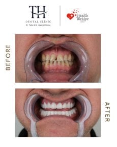 before-after photo zirconia-crown-installation