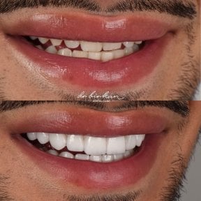 before-after photo zirconia-crown-installation