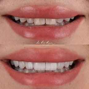 before-after photo zirconia-crown-installation