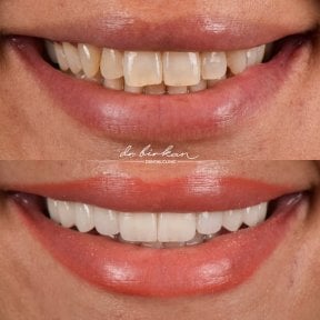 before-after photo zirconia-crown-installation