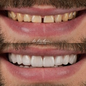 before-after photo zirconia-crown-installation