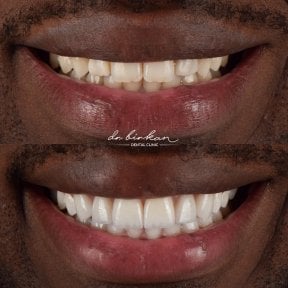 before-after photo zirconia-crown-installation