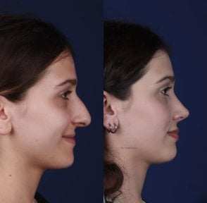 before-after photo rhinoplasty-nose-job