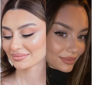 before-after photo rhinoplasty-nose-job