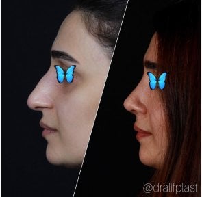 before-after photo rhinoplasty-nose-job
