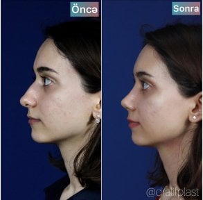 before-after photo rhinoplasty-nose-job