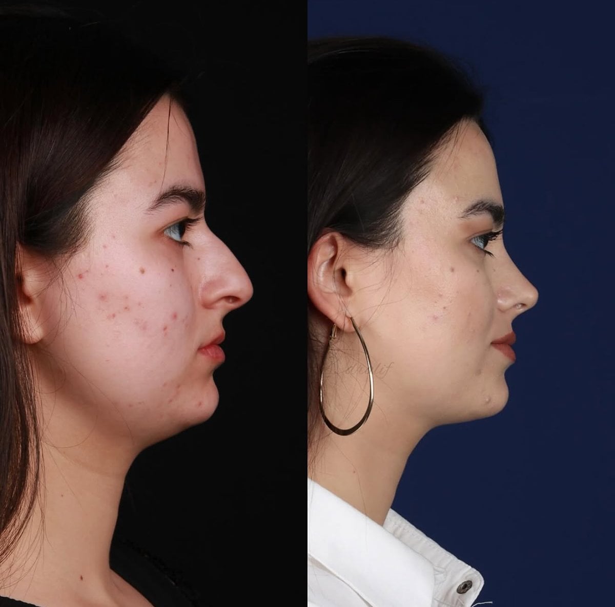 نتائج عملية تجميل الأنف قبل وبعد في National Prime Hospital، تحسين شكل الأنف