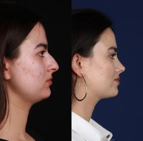 before-after photo rhinoplasty-nose-job