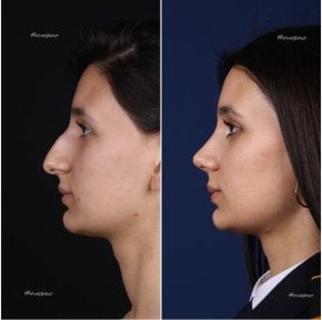 before-after photo rhinoplasty-nose-job