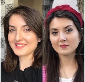 before-after photo rhinoplasty-nose-job