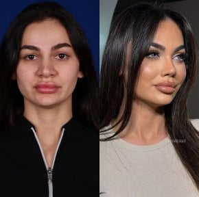 before-after photo rhinoplasty-nose-job