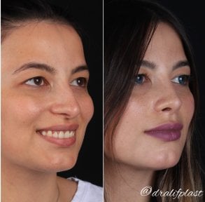 before-after photo rhinoplasty-nose-job