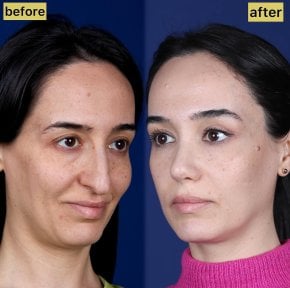 before-after photo rhinoplasty-nose-job