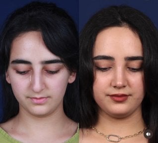 before-after photo rhinoplasty-nose-job