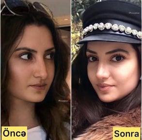 before-after photo rhinoplasty-nose-job