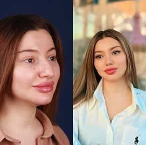 before-after photo rhinoplasty-nose-job