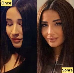 before-after photo rhinoplasty-nose-job