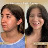 Before and after buccal fat removal and double chin lipo results at Dr. Safa Manav Clinic