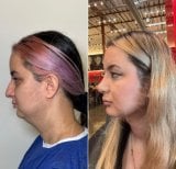 Before and after buccal fat extraction at Dr. Safa Manav Clinic, slimmer facial contour result