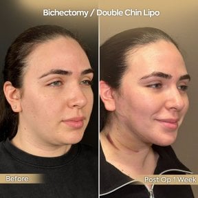 Before and after buccal fat removal and double chin lipo results at Dr. Safa Manav Clinic