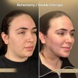 Before and after buccal fat removal and double chin lipo results at Dr. Safa Manav Clinic