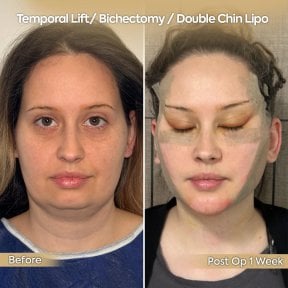 Before and after buccal fat extraction, temporal lift, and chin lipo at Dr. Safa Manav Clinic
