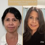 Before and after face and neck lift, upper eye lift, buccal fat removal at Dr. Safa Manav Clinic