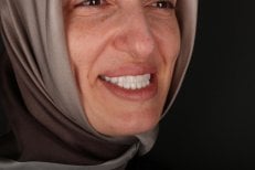 All-on-6 dental implants result – restored smile and natural-looking teeth after procedure