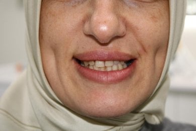 Before All-on-6 dental implants at clinic – missing and discolored teeth visible