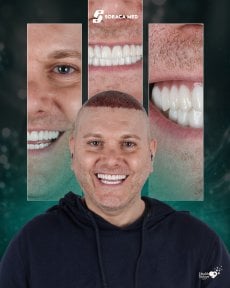 before-after photo hollywood-smile