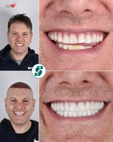 before-after photo zirconia-crown-installation