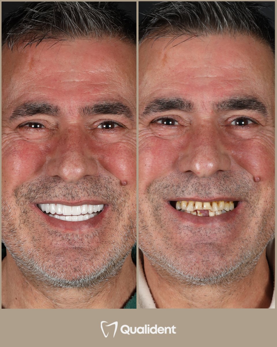 Resultado antes y después de implantes dentales All-on-4 en Schneider Center for Children Medicine