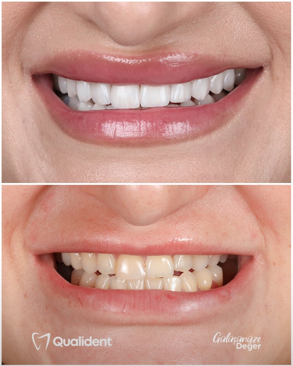 before-after photo