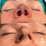 Resultados antes y después de rinoplastia de revisión en Lokman Hekim Istanbul Hospital, forma de nariz mejorada