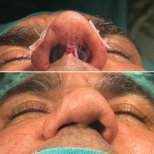 Resultados de rinoplastia de revisión antes y después en Lokman Hekim Istanbul Hospital, forma mejorada