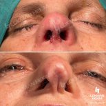 Resultados antes y después de rinoplastia de revisión en Lokman Hekim Istanbul Hospital, forma de nariz mejorada