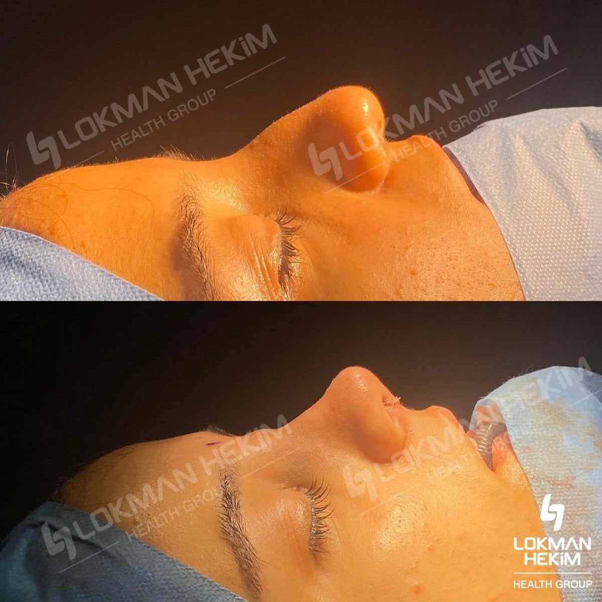 Resultados antes y después de rinoplastia de revisión en Lokman Hekim Istanbul Hospital, remodelación nasal