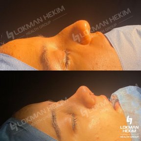 Resultados antes y después de rinoplastia de revisión en Lokman Hekim Istanbul Hospital, remodelación nasal