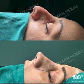 Resultados antes y después de rinoplastia de revisión en Lokman Hekim Istanbul Hospital, remodelación nasal