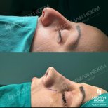 Resultados antes y después de rinoplastia de revisión en Lokman Hekim Istanbul Hospital, remodelación nasal