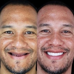 before-after photo implantacia-zuba