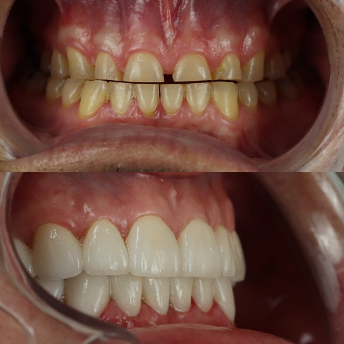 Resultados antes y después de coronas de porcelana en Smile 4 Ever Mexico, restauración de sonrisa