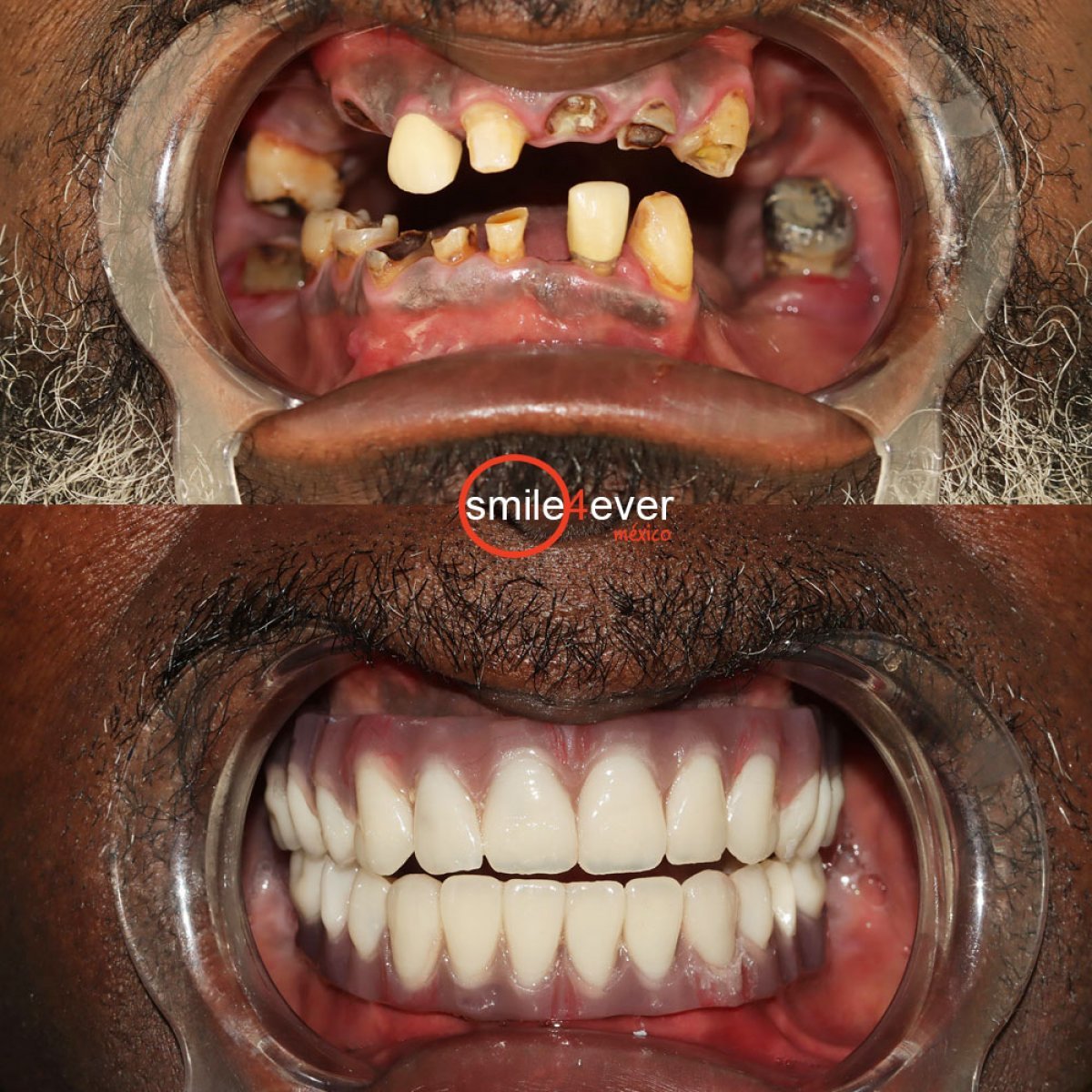 نتيجة قبل وبعد زراعة الأسنان All-on-4 في Smile 4 Ever Mexico، استعادة الابتسامة الكاملة