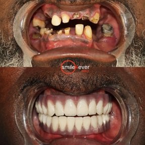 before-after photo implantaciya-zubov-po-tehnologii-all-on-4--vse-na-chetureh