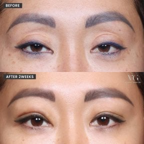 Blefaroplastyka przed i po w VG Plastic Surgery, korekta powiek po 2 tygodniach