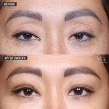 Blefaroplastyka przed i po w VG Plastic Surgery, korekta powiek po 2 tygodniach