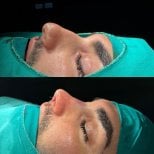 Before and after rhinoplasty results at Optimed International Hospital, improved nose shape