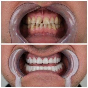 before-after photo zirconia-crown-installation