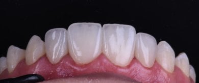 before-after photo dental-implant