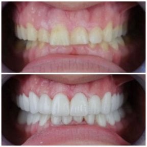 before-after photo zirconia-crown-installation
